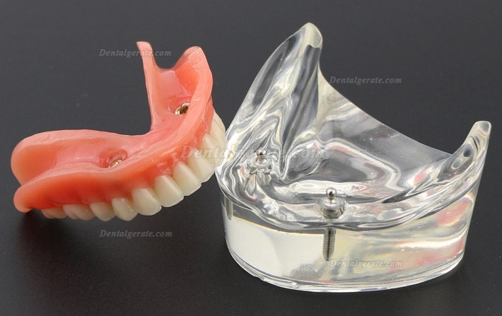 Modell f&uuml;r Zahnz&auml;hne &Uuml;berprothese minderwertig bei 2 Implantaten Demo-Modell 6002 01